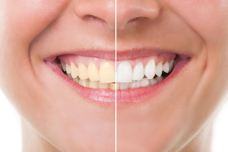 Teeth Whitening in Walnut Creek